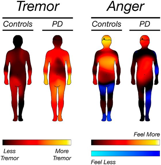 Kuva 2. Vapinan ja suuttumuksen aiheuttamat kehon tuntemukset kontrollihenkilöillä ja parkinsonpotilailla. Julkaisusta Niemi ym. [14].