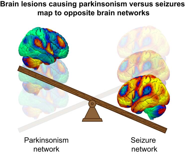 Bild 6. Nervnäten skiljer sig åt vid parkinsonismer och epilepsianfall som beror på lesioner. Ur artikeln Schaper m.fl. [33].